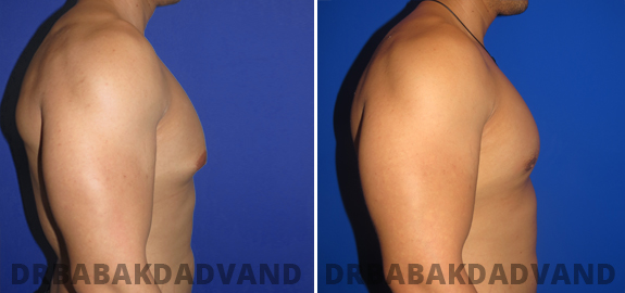 Before and After Photos. Gynecomastia. 4